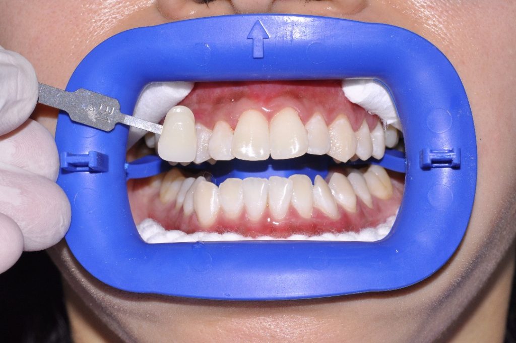 Curious about teeth whitening treatments? Here’s what you need to know 5