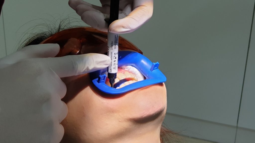 Getting a million dollar smile - the Zoom teeth whitening experience from start to finish 4