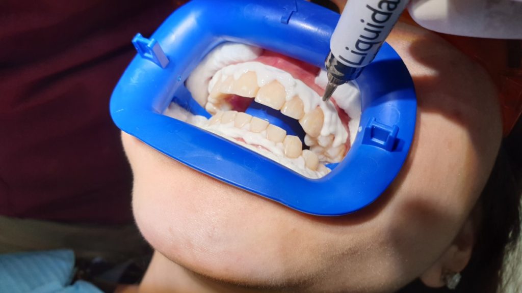 The Liquidam resin is applied onto the patient's gums to protect them during the Zoom teeth whitening procedure