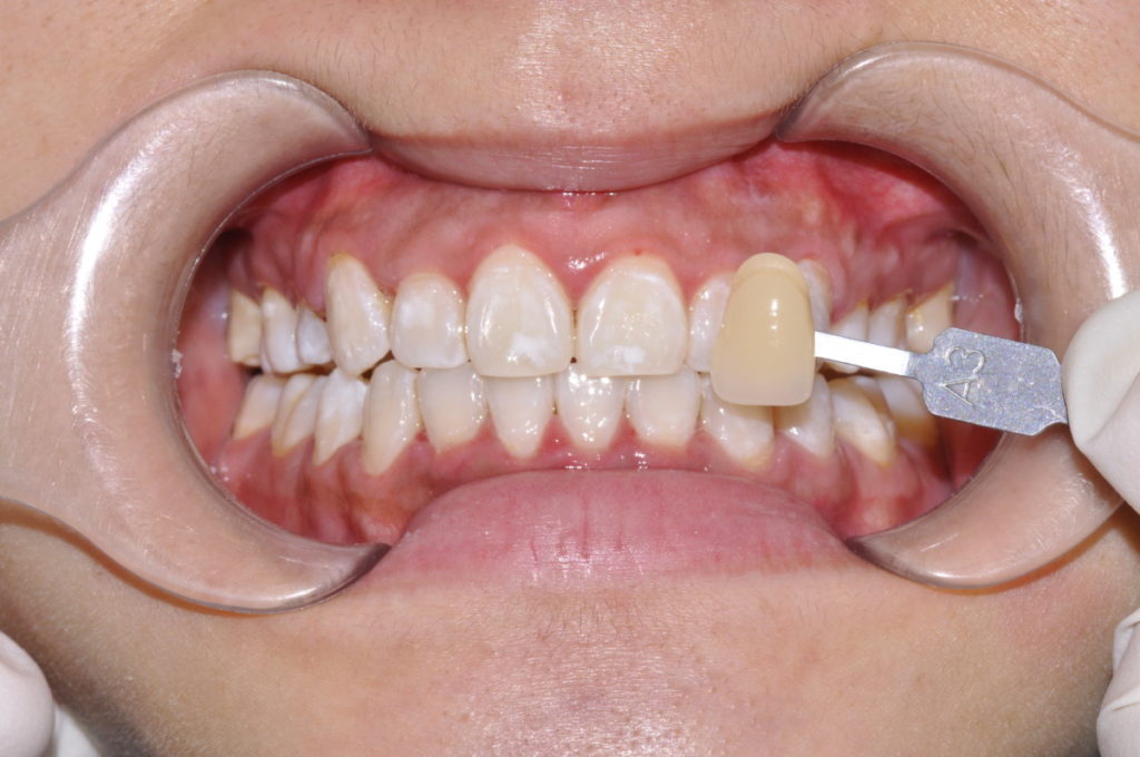 After the Zoom teeth whitening treatment. The shade guide is shown to display the improvement from the patient's original shade in her teeth.
