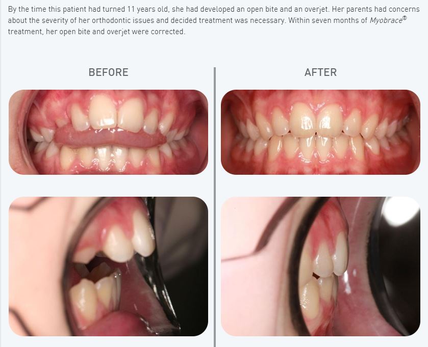 Myobrace System straightens crooked teeth naturally now available at We Smile Dental Clinic KL 2