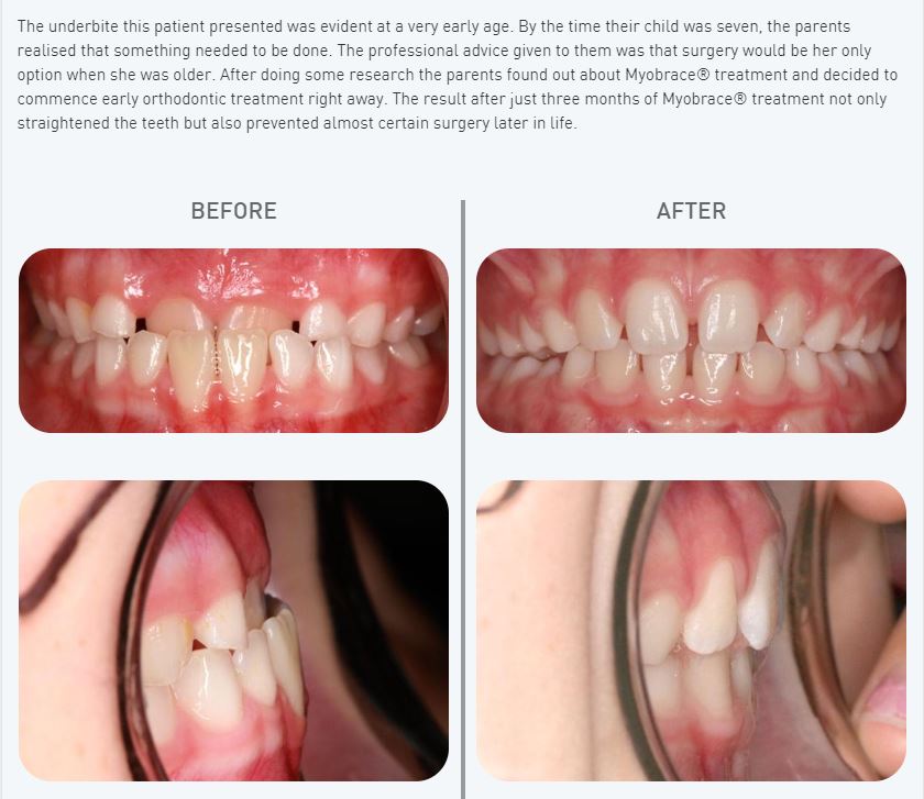 Myobrace System straightens crooked teeth naturally now available at We Smile Dental Clinic KL 3